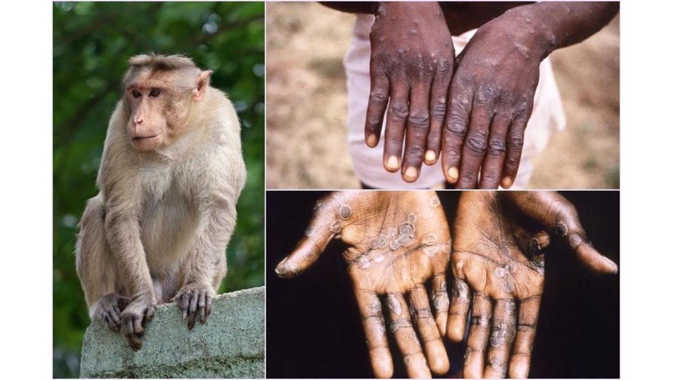 Bộ Y tế khuyến cáo 6 biện pháp phòng chống bệnh đậu mùa khỉ